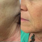 Before & after 1 RF Microneedling & Co2 treatment