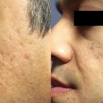 Before & after 1 RF Microneedling treatment