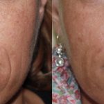 before & after 1 RF Microneedling treatment