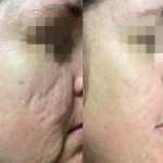 Before & after 1 RF Microneedling treatment