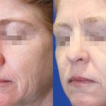 before & after 2 treatments of RF Microneedling