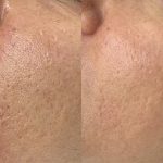 Before & 2 weeks after 1 RF Microneedling & Co2 session