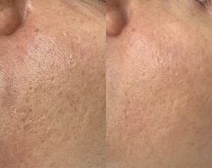 Before & 2 weeks after 1 RF Microneedling & Co2 session