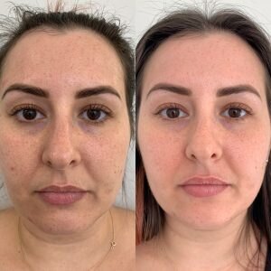 Before & 2 weeks after 1 RF Microneedling & Co2 session