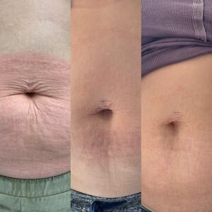 Mummy Tummy treated with RF Microneedling